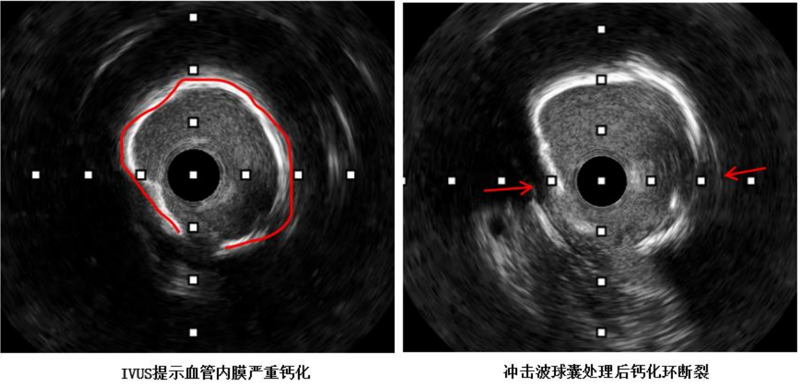 冠脉介入治疗新突破 | 中山一院广西医院应用国产创新器械攻克冠脉钙化难题